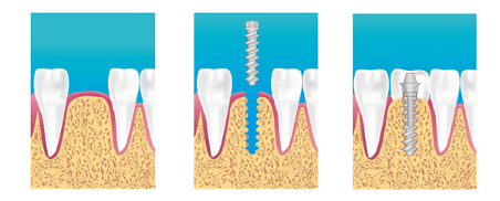 implant dentaire Francheville Craponne Chaponost
