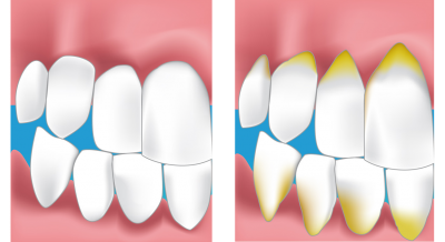 dentiste gencive craponne 