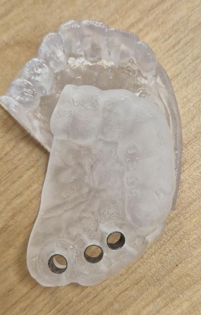 Guide chirurgical 3 D implant docteur renaud